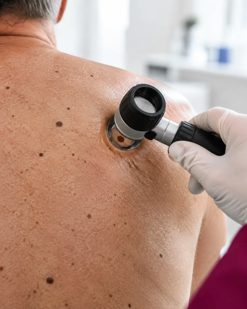 La dermatologa esamina un neo con il dermatoscopio